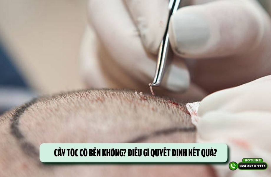 Cấy tóc có bền không? Điều gì quyết định kết quả?