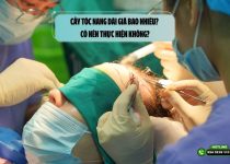 Cấy tóc nang dài giá bao nhiêu? Có nên thực hiện không?