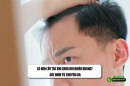Có nên cấy tóc khi chưa hói nhiều không? Góc nhìn từ chuyên gia