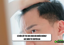 Có nên cấy tóc khi chưa hói nhiều không? Góc nhìn từ chuyên gia