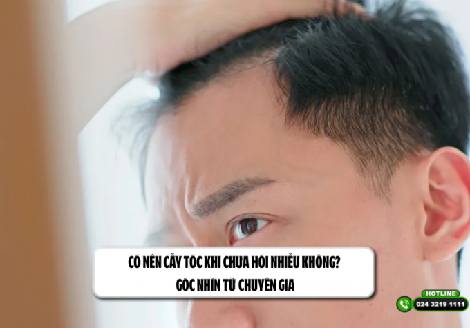Có nên cấy tóc khi chưa hói nhiều không? Góc nhìn từ chuyên gia
