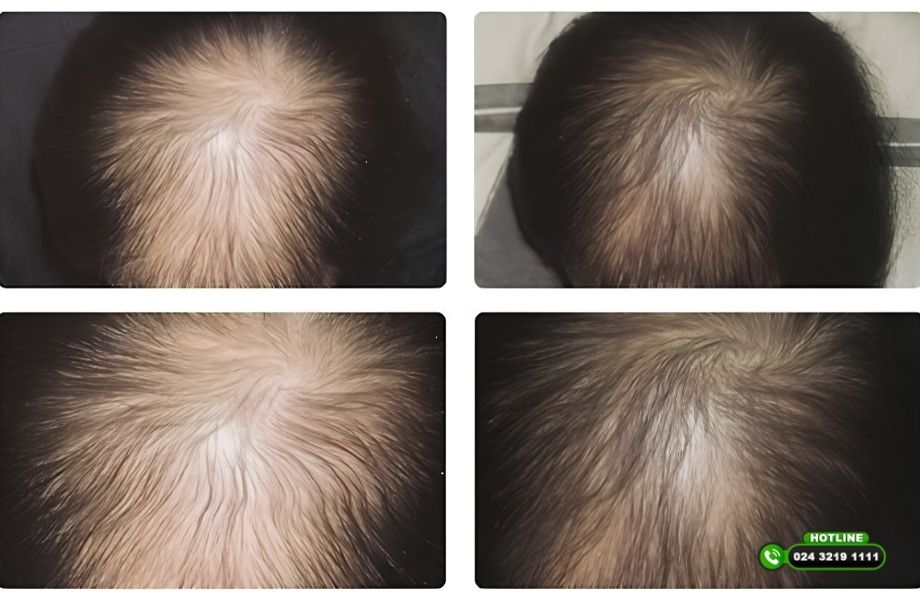 Hóa trị có rụng tóc không? Sự thật khiến nhiều bệnh nhân ung thư bất ngờ