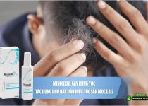 Minoxidil gây rụng tóc: Tác dụng phụ hay dấu hiệu tóc sắp mọc lại?