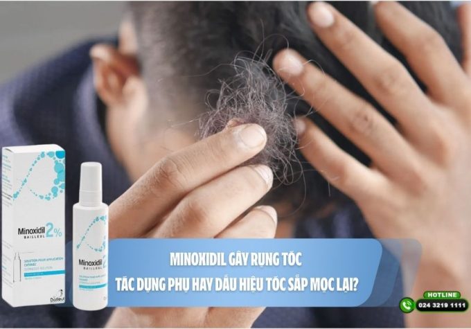 Minoxidil gây rụng tóc: Tác dụng phụ hay dấu hiệu tóc sắp mọc lại?