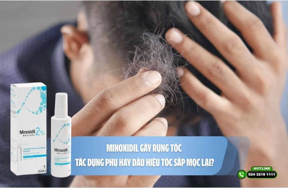 Minoxidil gây rụng tóc: Tác dụng phụ hay dấu hiệu tóc sắp mọc lại?