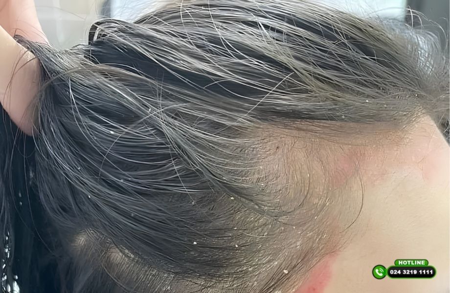 Rụng tóc do nấm có mọc lại không? Điều trị sớm quyết định khả năng phục hồi