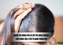 Người tóc mỏng yếu có cấy tóc được không? Phụ thuộc vào 3 yếu tố quan trọng này