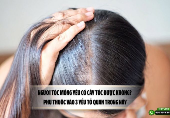 Người tóc mỏng yếu có cấy tóc được không? Phụ thuộc vào 3 yếu tố quan trọng này