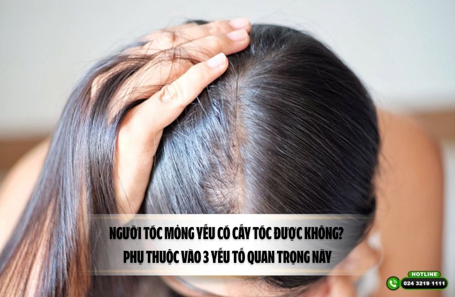 Người tóc mỏng yếu có cấy tóc được không? Phụ thuộc vào 3 yếu tố quan trọng này