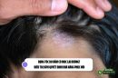 Rụng tóc do nấm có mọc lại không? Điều trị sớm quyết định khả năng phục hồi