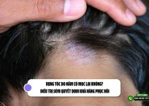 Rụng tóc do nấm có mọc lại không? Điều trị sớm quyết định khả năng phục hồi