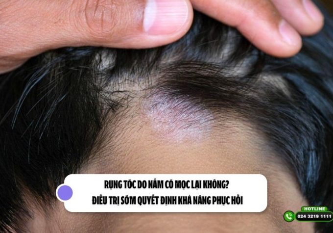 Rụng tóc do nấm có mọc lại không? Điều trị sớm quyết định khả năng phục hồi