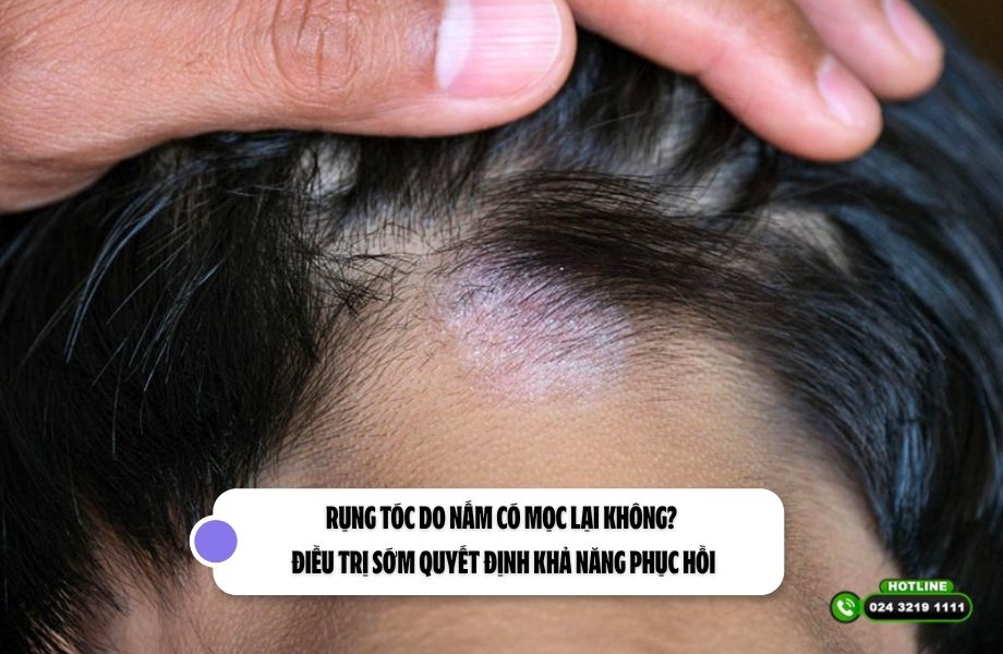 Rụng tóc do nấm có mọc lại không? Điều trị sớm quyết định khả năng phục hồi