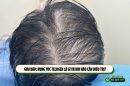 Giải đáp: Rụng tóc telogen là gì và khi nào cần điều trị?