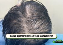 Giải đáp: Rụng tóc telogen là gì và khi nào cần điều trị?
