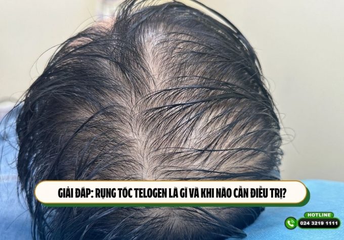 Giải đáp: Rụng tóc telogen là gì và khi nào cần điều trị?