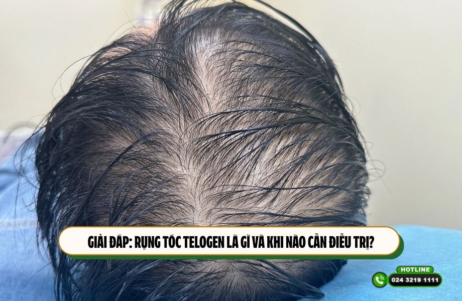 Giải đáp: Rụng tóc telogen là gì và khi nào cần điều trị?