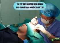 Tóc cấy sau 2 năm có bị rụng không? Điều gì quyết định độ bền của tóc cấy?