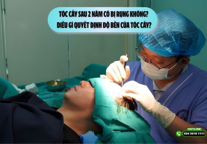 Tóc cấy sau 2 năm có bị rụng không? Điều gì quyết định độ bền của tóc cấy?