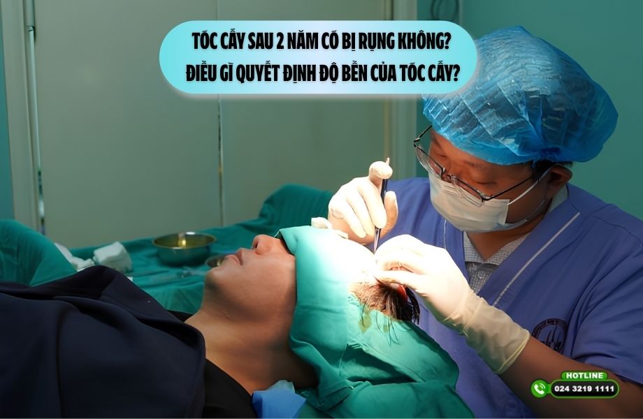 Tóc cấy sau 2 năm có bị rụng không? Điều gì quyết định độ bền của tóc cấy?