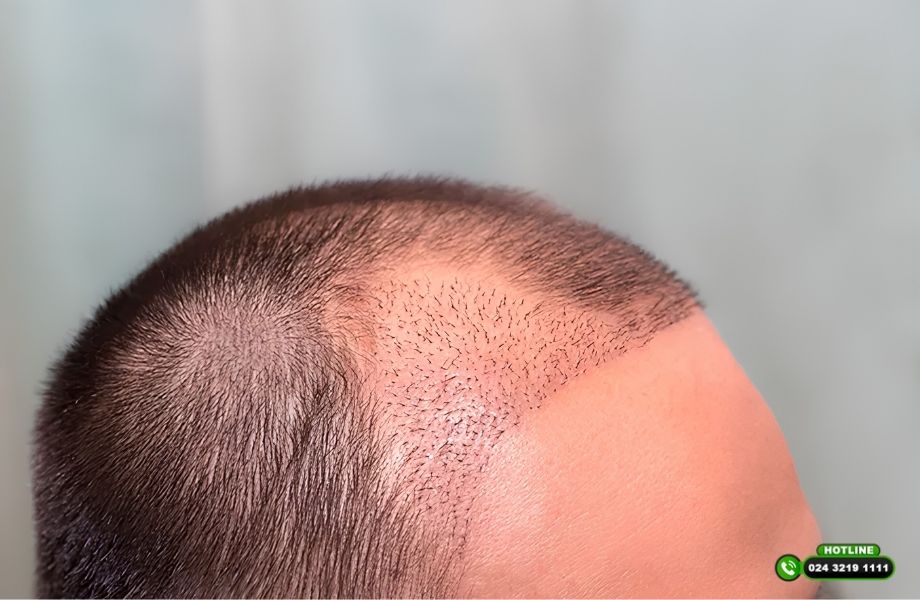 Vì sao cấy tóc xong vẫn bị thưa? Đừng vội kết luận thất bại nếu bạn chưa biết điều này