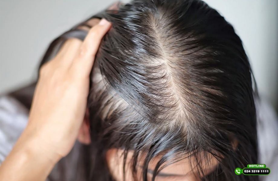 Người tóc mỏng yếu có cấy tóc được không? Phụ thuộc vào 3 yếu tố quan trọng này