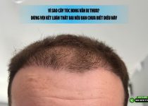 Vì sao cấy tóc xong vẫn bị thưa? Đừng vội kết luận thất bại nếu bạn chưa biết điều này