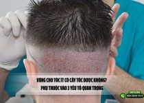 Vùng cho tóc ít có cấy tóc được không? Phụ thuộc vào 3 yếu tố quan trọng