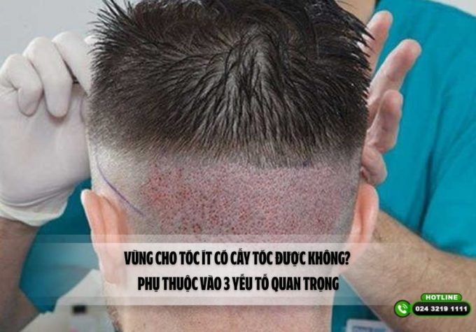 Vùng cho tóc ít có cấy tóc được không? Phụ thuộc vào 3 yếu tố quan trọng