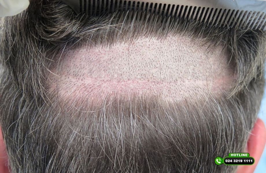 Vùng cho tóc ít có cấy tóc được không? Phụ thuộc vào 3 yếu tố quan trọng
