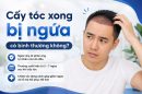Chuyên gia giải đáp: Cấy tóc xong bị ngứa có bình thường không?
