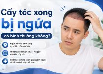 Cấy tóc xong bị ngứa có bình thường không