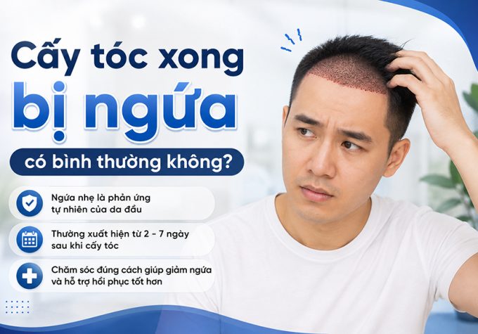 Chuyên gia giải đáp: Cấy tóc xong bị ngứa có bình thường không?