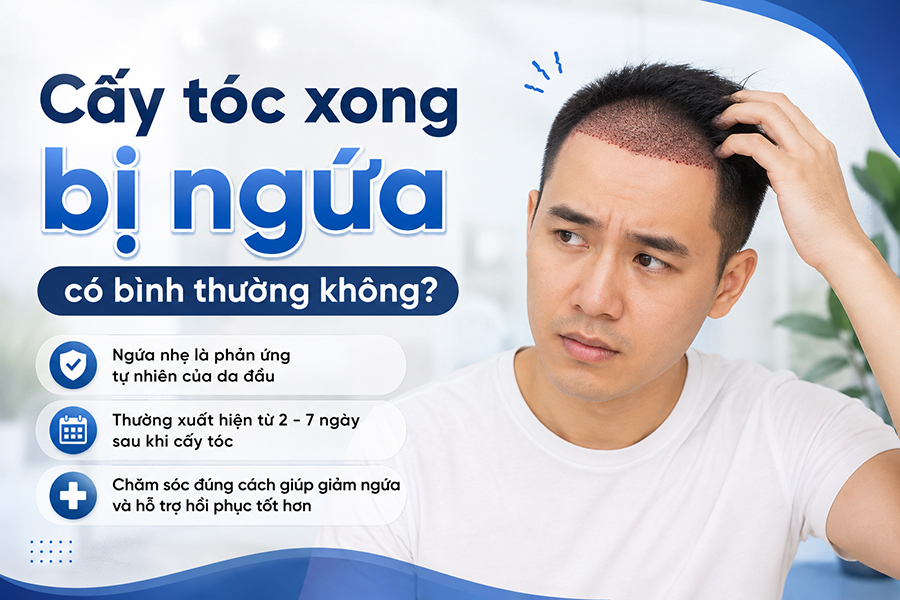 Chuyên gia giải đáp: Cấy tóc xong bị ngứa có bình thường không?