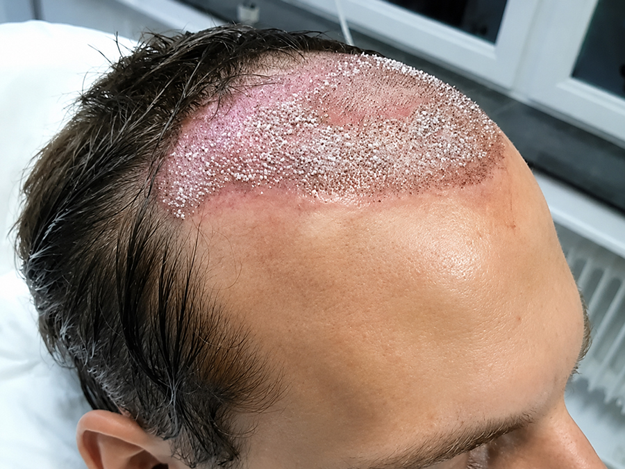 Vì sao cần kiểm soát tình trạng viêm trước khi cấy tóc