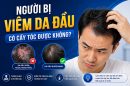 Người bị viêm da đầu có cấy tóc được không? Bác sĩ giải đáp