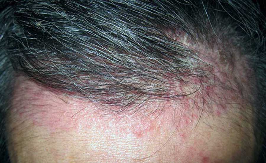 Người bị viêm da đầu có cấy tóc được không