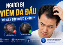 Người bị viêm da đầu có cấy tóc được không