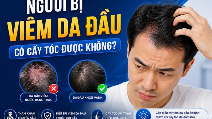 Người bị viêm da đầu có cấy tóc được không