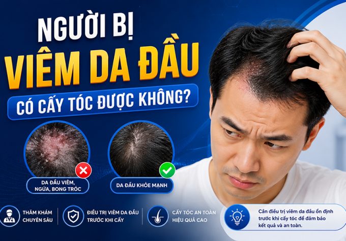 Người bị viêm da đầu có cấy tóc được không? Bác sĩ giải đáp
