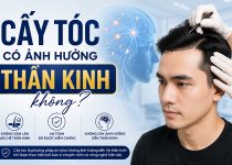 cấy tóc có ảnh hưởng thần kinh không