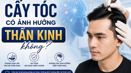cấy tóc có ảnh hưởng thần kinh không