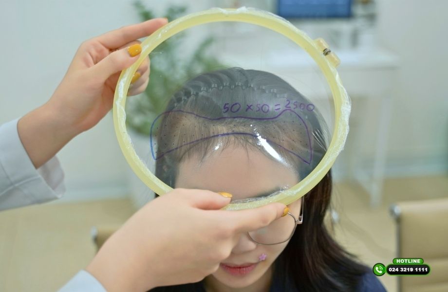 Cấy tóc mật độ bao nhiêu là đẹp? Có phải cấy càng dày càng tốt?