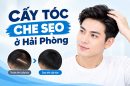 Cấy tóc che sẹo ở Hải Phòng có hiệu quả không?