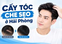 Cấy tóc che sẹo ở Hải Phòng có hiệu quả không?