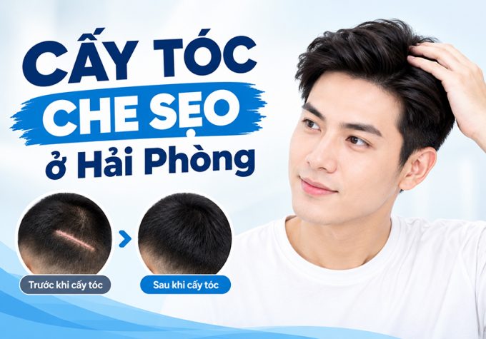 Cấy tóc che sẹo ở Hải Phòng có hiệu quả không?