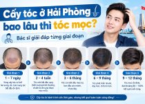 Cấy tóc ở Hải Phòng bao lâu thì tóc mọc? Bác sĩ giải đáp từng giai đoạn
