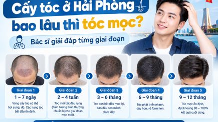 Cấy tóc ở Hải Phòng bao lâu thì tóc mọc? Bác sĩ giải đáp từng giai đoạn