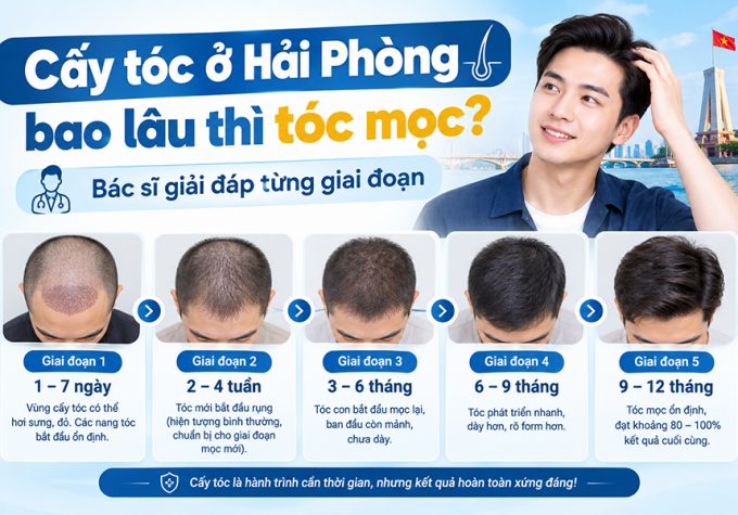 Cấy tóc ở Hải Phòng bao lâu thì tóc mọc? Bác sĩ giải đáp từng giai đoạn