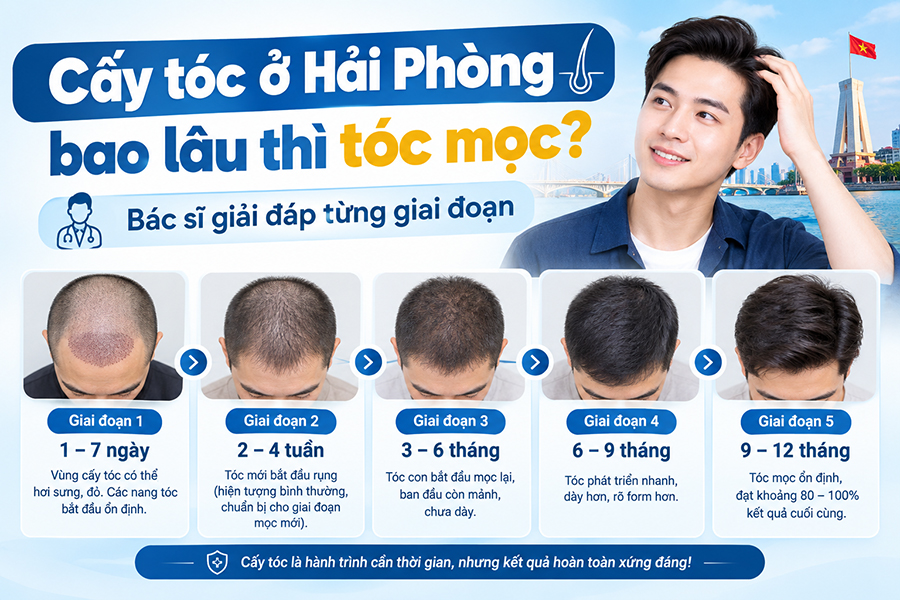 Cấy tóc ở Hải Phòng bao lâu thì tóc mọc? Bác sĩ giải đáp từng giai đoạn
